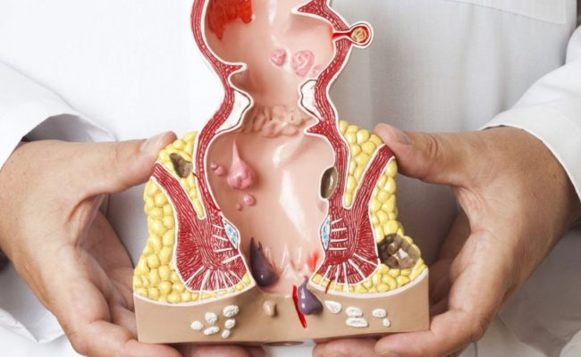 التخلص من البواسير في دقيقتين