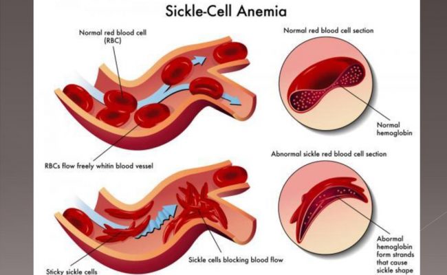 ما هو الهيموجلوبين