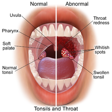 220px-blausen_0860_tonsils26throat_anatomy.png