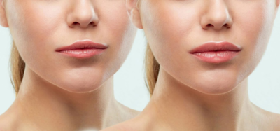 014817d4870b915ac3c6b8f2969781a2-1 أسئلة شائعة حول الفيلر