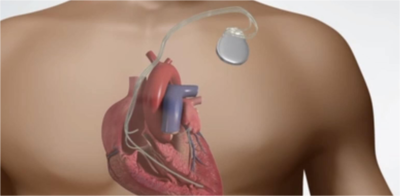 01da7e72ed63b3c99f5602df0a3c23d8-1 مزيل الرجفان القلبي