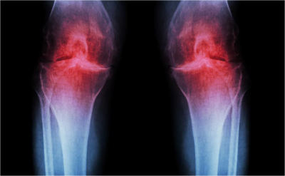 0a9b9c0be1bf2594efc3f53f4f3fea09-1 كيف نحمي أنفسنا من خشونة المفاصل