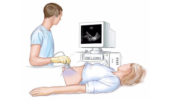 الرحم المقلوب