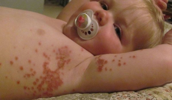 القوباء عند الاطفال