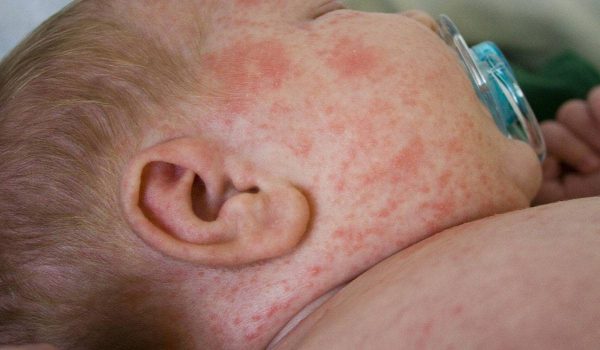 1-58-8 علاج حمو النيل