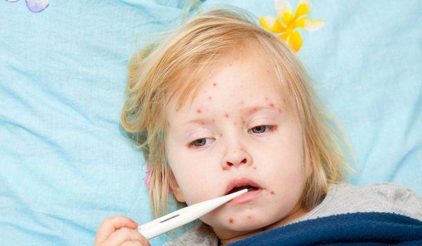 اعراض الحصبة عند الاطفال