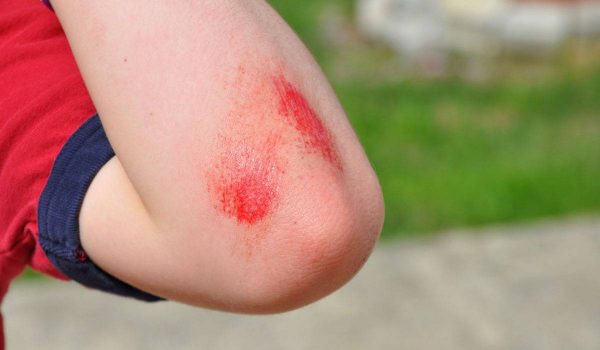 جروح الاطفال