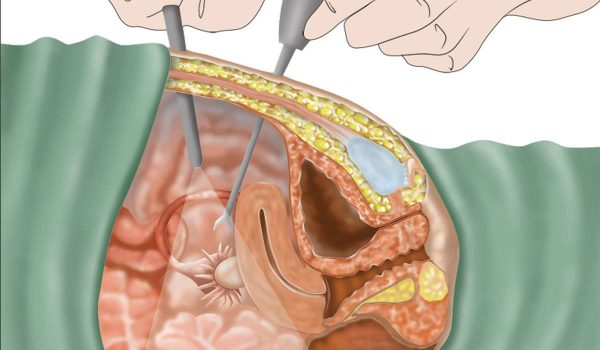 عملية استئصال الرحم