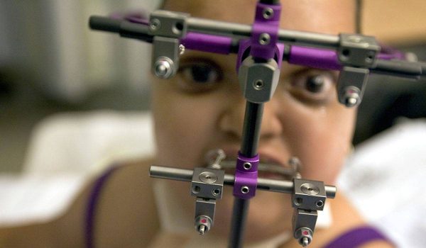 متلازمة كروزون