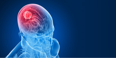 1fb83d6235d3fa2e21f20c9bc9fb4935-1 استئصال ورم من الدماغ