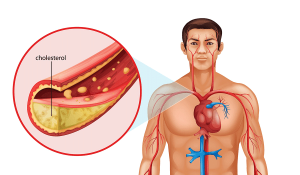 Cholesterol