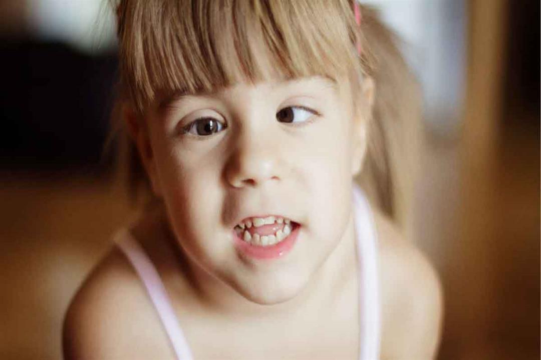 باختلاف أنواعه.. طبيب يطمئن الأمهات: الحول يمكن علاجه بسهولة