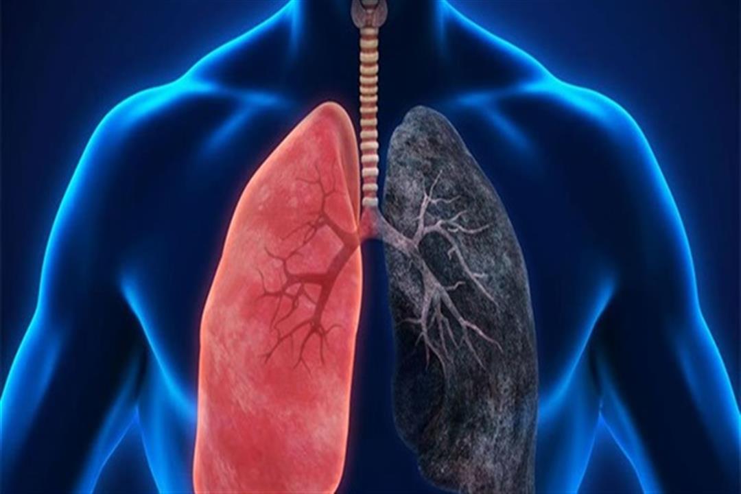 بالفيديو.. كيف يدمر فيروس كورونا رئة المصابين؟