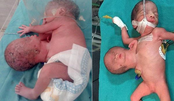 التوأم الطفيلي