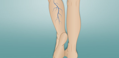 22e13a99f9be5ac675397d7378fc1d8e-1 الطرق الحديثة لعلاج الدوالي ومضاعفاتها