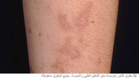 الجزر الأبيض الجزر الأبيض