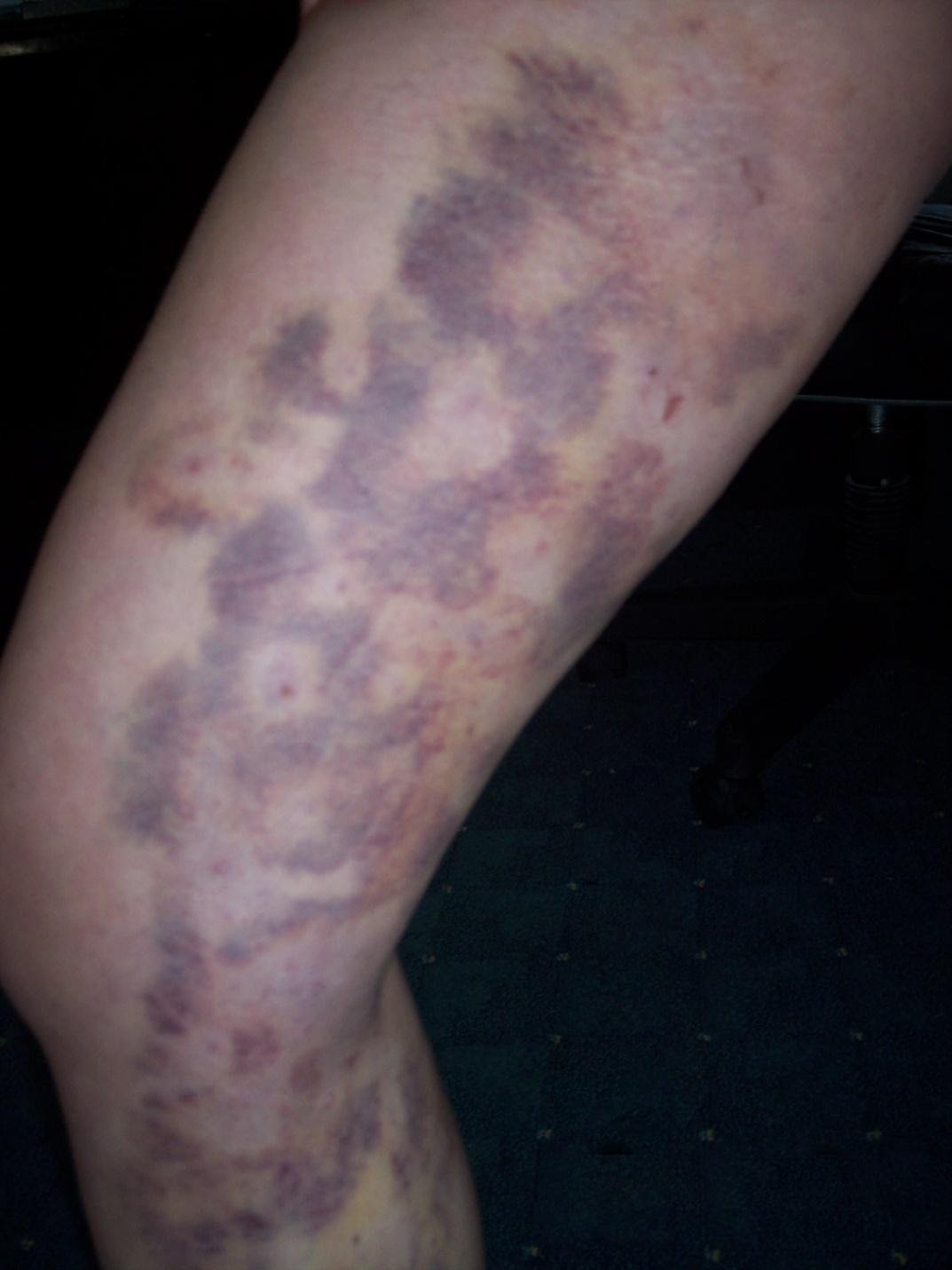 2a68042e5a9957de864d8e6d40a3a020 المضاعفات الناتجة عن العلاج بالذبذبة الحرارية