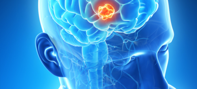 2ba22123fcacac8bc868e586248944f5-1 علامات خطيرة قد يكون سببها ورم دماغي