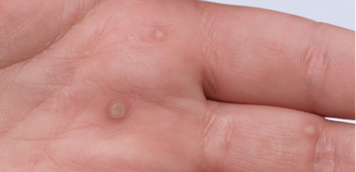 2c207072f65ed72135727f369774b720-1 السنط الجلدي