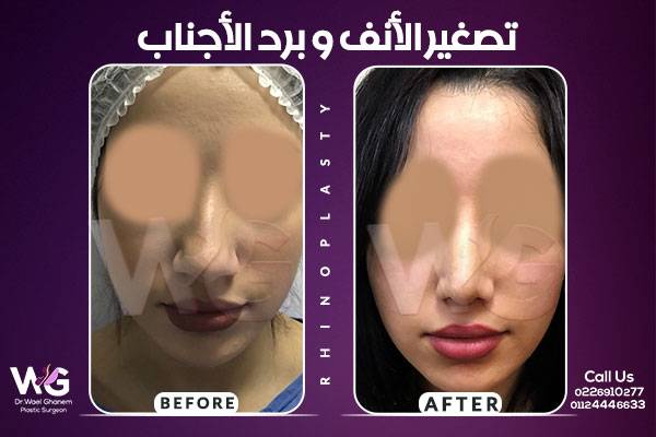 عملية تصغير الأنف