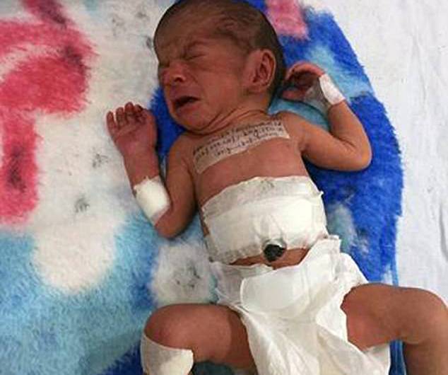 التوأم الطفيلي