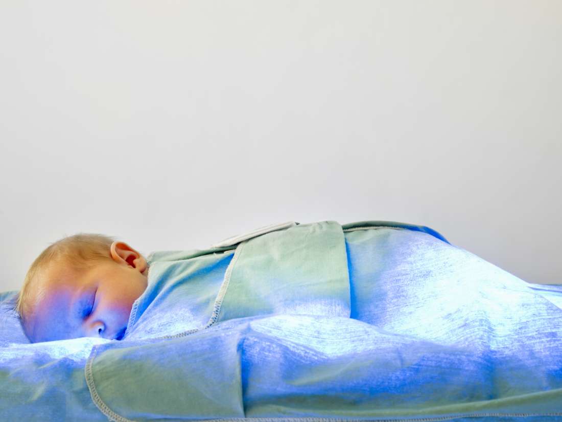 Image result for jaundice in kids