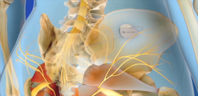 3dfc48c5fc1d609cabc1be533b57e3cd-1 التقنيات الحديثة في علاج مشاكل التبول: تحفيز الاعصاب الجذعية (Sacral Neuromodulation)