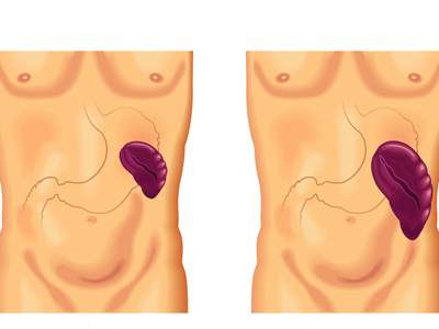 400x3001 تضخم الطحال