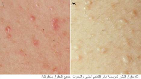 الطفح الحراري الطفح الحراري