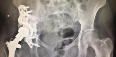 4a1c2c838135aa5b7689ae15ebbf0bd7-1 استبدال مفصل الورك بالكامل: الاحتياطات بعد استبدال المفصل