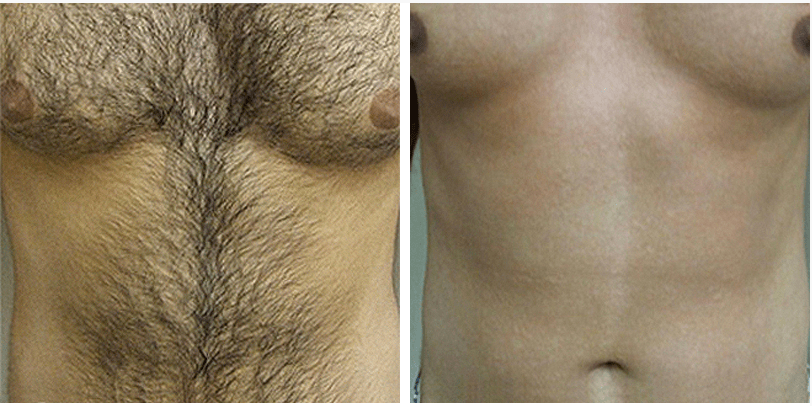 5-5 ازالة الشعر بالليزر للرجال