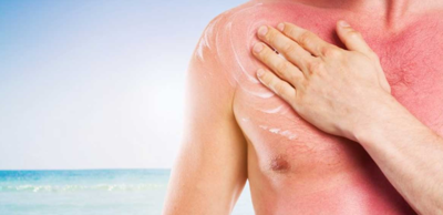 54742a8bc4232b82ef88dbc1f91d442b-1 حروق الشمس وتأثير الطقس عليها