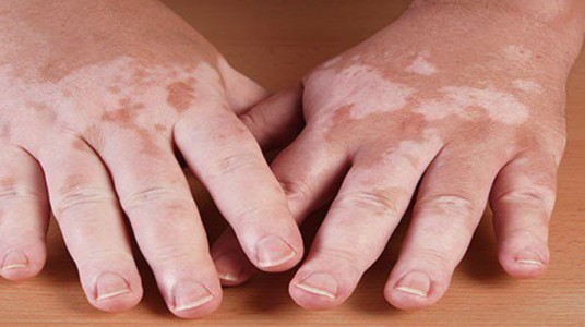 548570ea6659carticle__1-1 إضطرابات نقص التصبغ ( البهق )