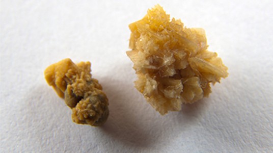 54913fe37248aarticle_2717_1-1 حصى الكلى وطرق علاجه