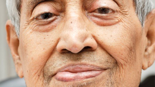 54a10e5cc0fccarticle_2739_1-1 شلل العصب الوجهي-facial palsy