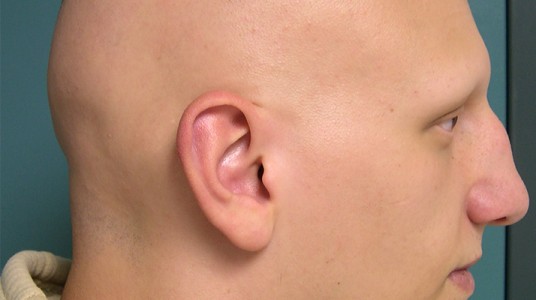 54e4586100c73article__1-1 تطوير علاج للثعلبة الخبيثة (الصلع الكامل) Alopecia Totalis