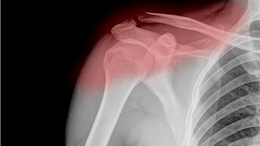 5506a5e652ae9article__1-1 أمراض الكتف