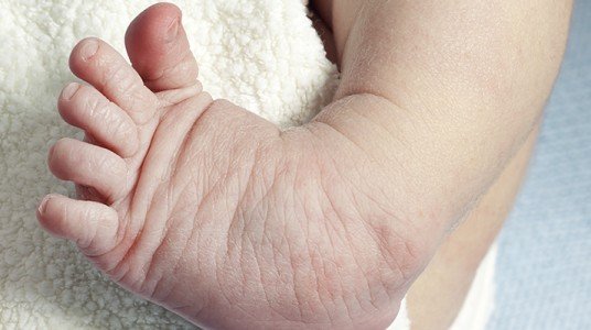 5517a43190420article__1-1 تشوهات القدم ، القدم الحنفاء