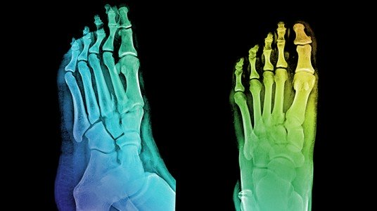 552b875dd3a3darticle_2957_1-1 تشوهات أصابع القدم