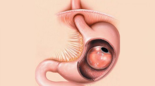 55c1cf1b07b5barticle_3099_1-1 بالونة المعدة بالمنظار؛ وسيلة آمنة و فعالة لفقدان الوزن.