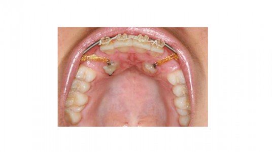 56386f491d666article_3236_1-1 الأنياب المطمورة؛ أسباب تكوينها وأهمية الحفاظ عليها