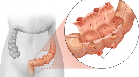 563f14d64fcc8article_3242_1-1 داء الرتوج في القولون (Diverticulitis)