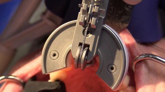 5651810301742article_3275_1-1 القلع اللارضحيّ تقدّمٌ جديدٌ في مجال طبّ الأسنان