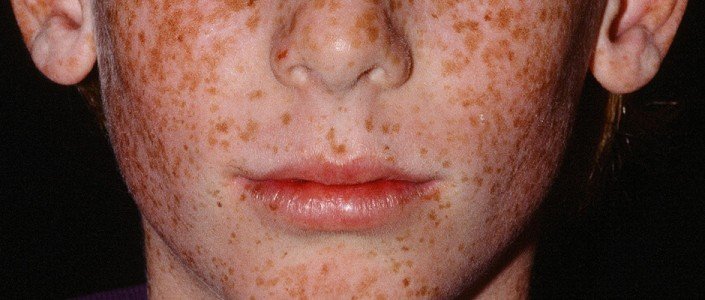 56e13b0aea6bbarticle_3406_1-1 متلازمة نيم