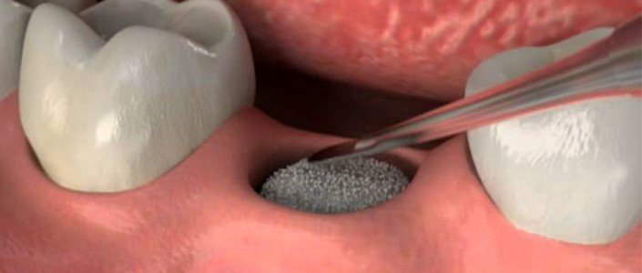 56e6aef6636a3article_3421_1-1 الطعوم العظمية في سياق المعالجة بالزرعات السنية