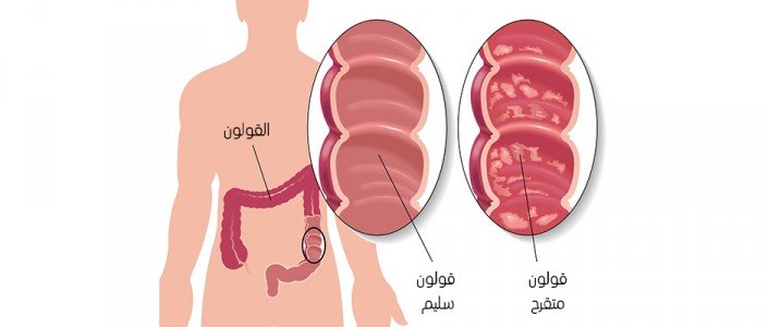57a0a89192436article_3545_1-1 تعرف على التهاب القولون التقرحي
