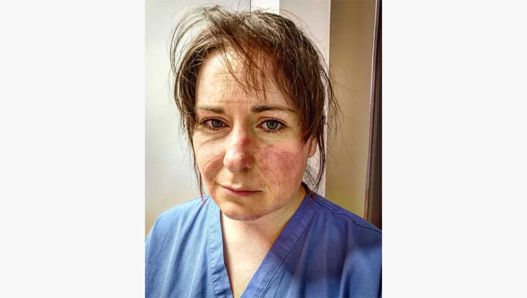 580-654 تعمل الممرضة البريطانية إيمي غولد 13 ساعة يوميا لإنقاذ المرضى بالعناية المركزة (مواقع التواصل)