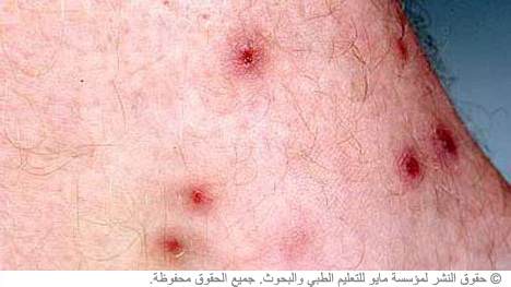 البق الأحمر البق الأحمر