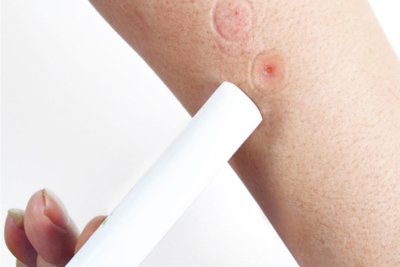 77a4af91139bc4a0b47dbdf68d2cb3a5-1 لدغة العقرب ولدغة الأفعى وإسعافاتهما الأولية