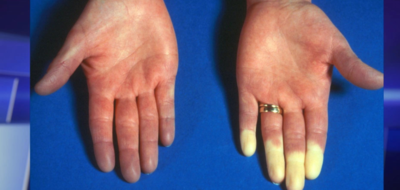 8a16eb6b1576da7e2021afc6dff3a396-1 ظاهرة راينود وعلاقتها ببرودة الطقس